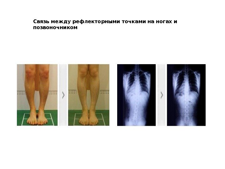 Связь между рефлекторными точками на ногах и позвоночником 